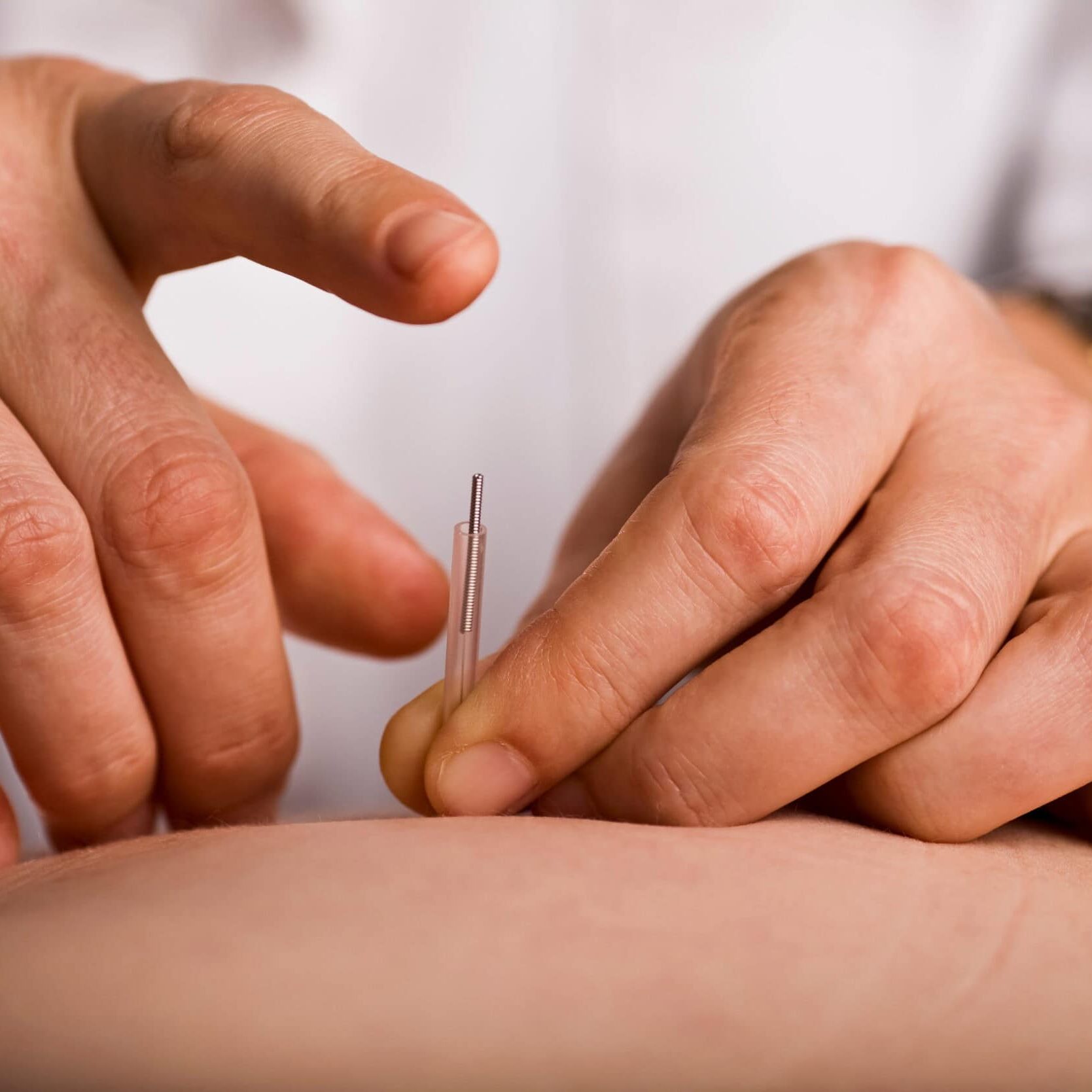 Acupuncturist prepares to tap needle into patients hand